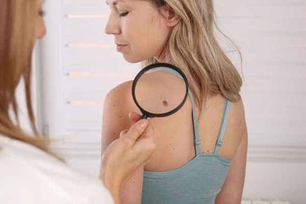 What Are Traditional Skin Lesion Removal Methods Farnham?