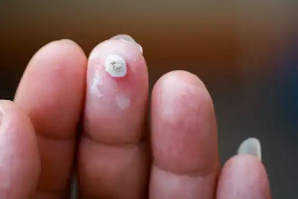 Image of white wart before cryopen treatment Farnham