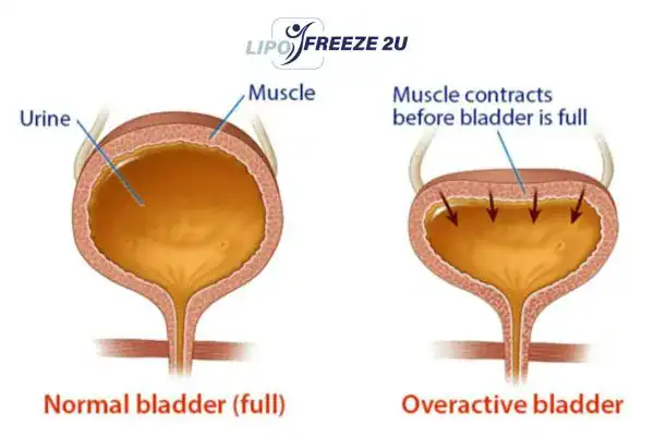 diagram of overactive bladder treatment Farnham