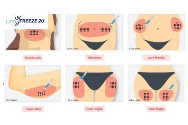 Benefits of Choosing Aqualyx for Fat Reduction Farnham