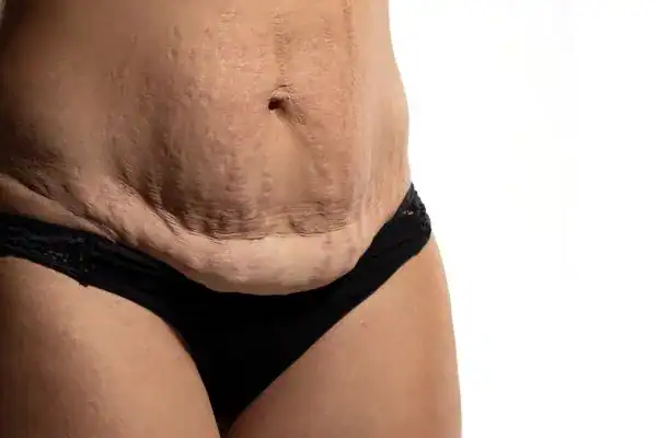 loose skin after weight loss injections Farnham
