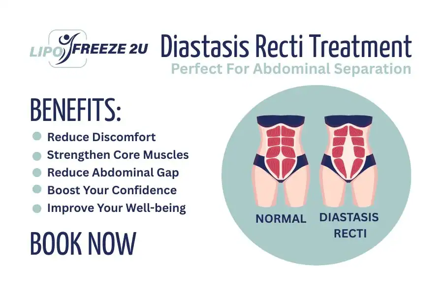 Benefits of body toning treatment Farnham for Diastasis recti