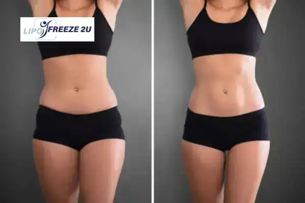 How Can LIPO FREEZE 2U Support Your Post-Pregnancy Body Recovery Farnham?