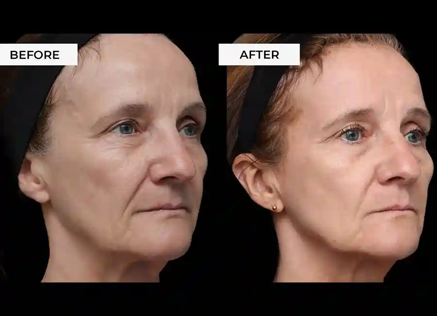 How Many RF Microneedling Sessions Will You Need to See a Difference Farnham?