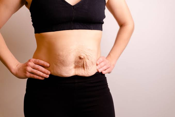 Is Surgery Really the Only Way to Repair Diastasis Recti Farnham?