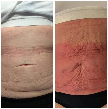 How Does RF Microneedling Improve Crepey, Thin and Uneven Skin Texture Farnham?