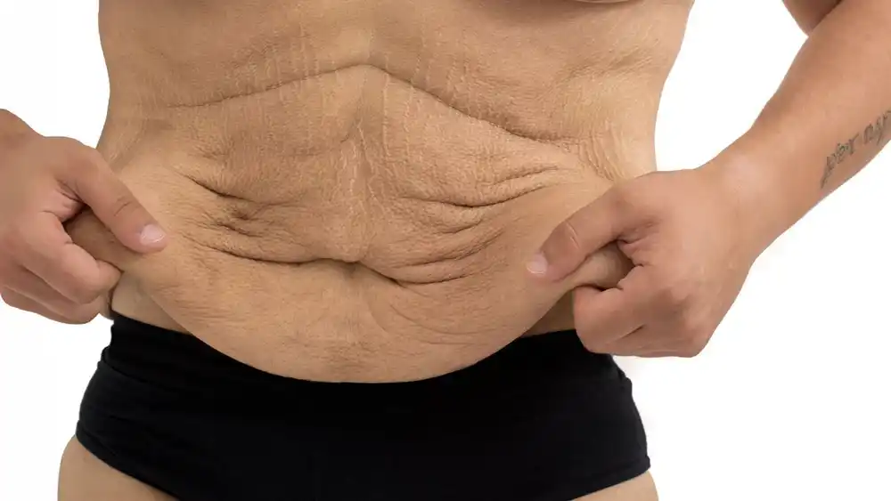 Why Does Weight Loss Medication Leave Some People With Loose or Sagging Skin Farnham?